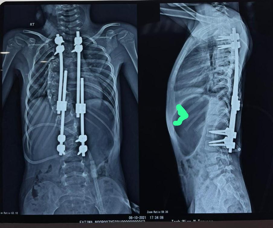 GROWING RODS FROM T2 TO T3