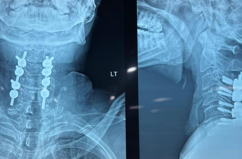 Lateral Mass Screw Fixation C3-C6 PD with misonix bonescalpel