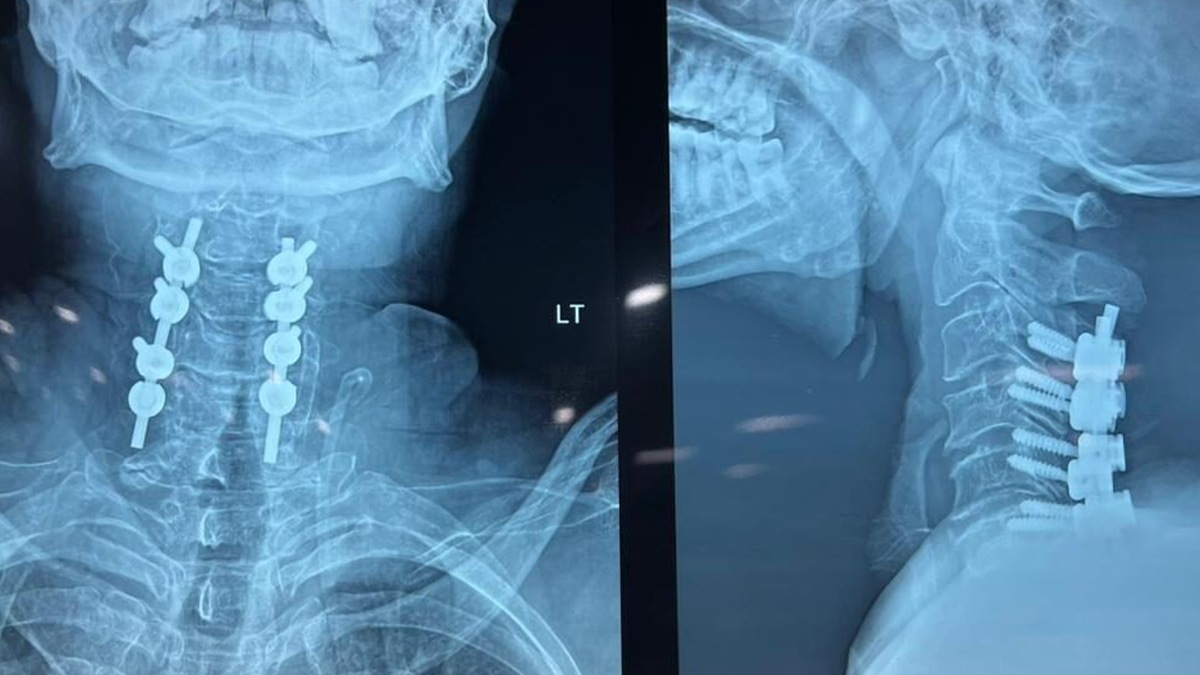 Lateral Mass Screw Fixation C3-C6 PD with misonix bonescalpel