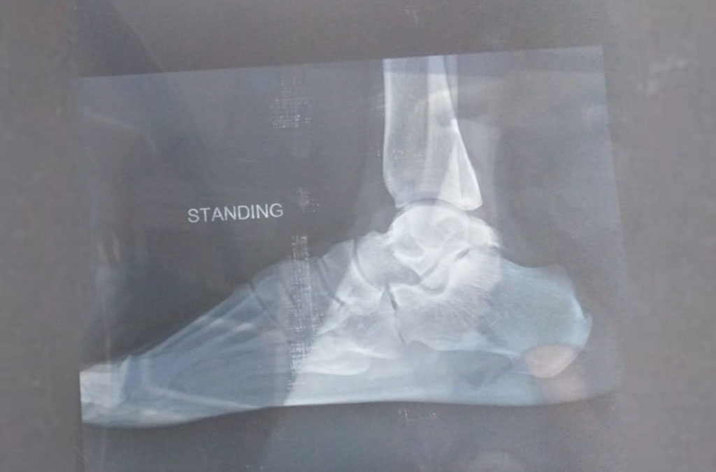 Management Of Talus Fracture