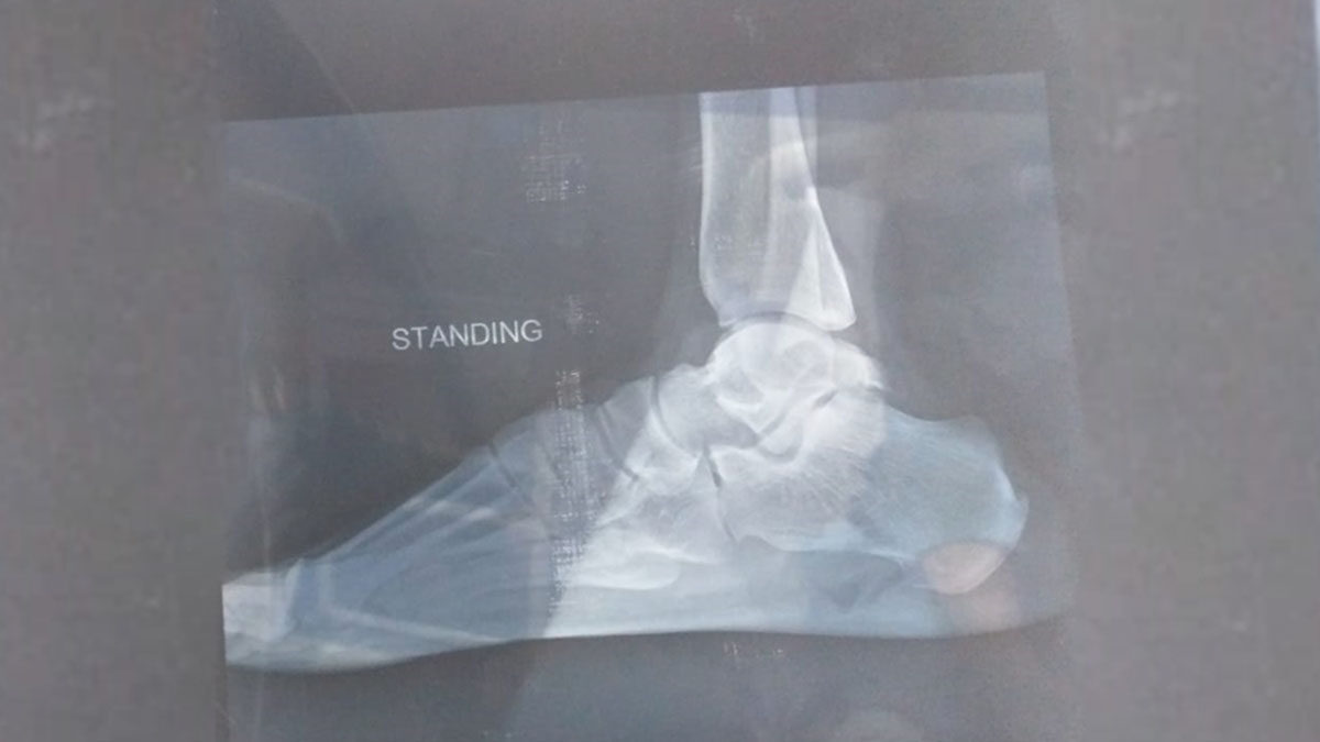 Management Of Talus Fracture