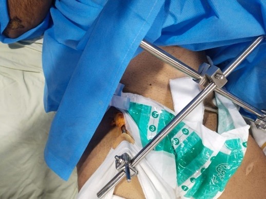 Nail and External Fixation Pelvis 1