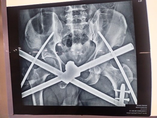Nail and External Fixation Pelvis2